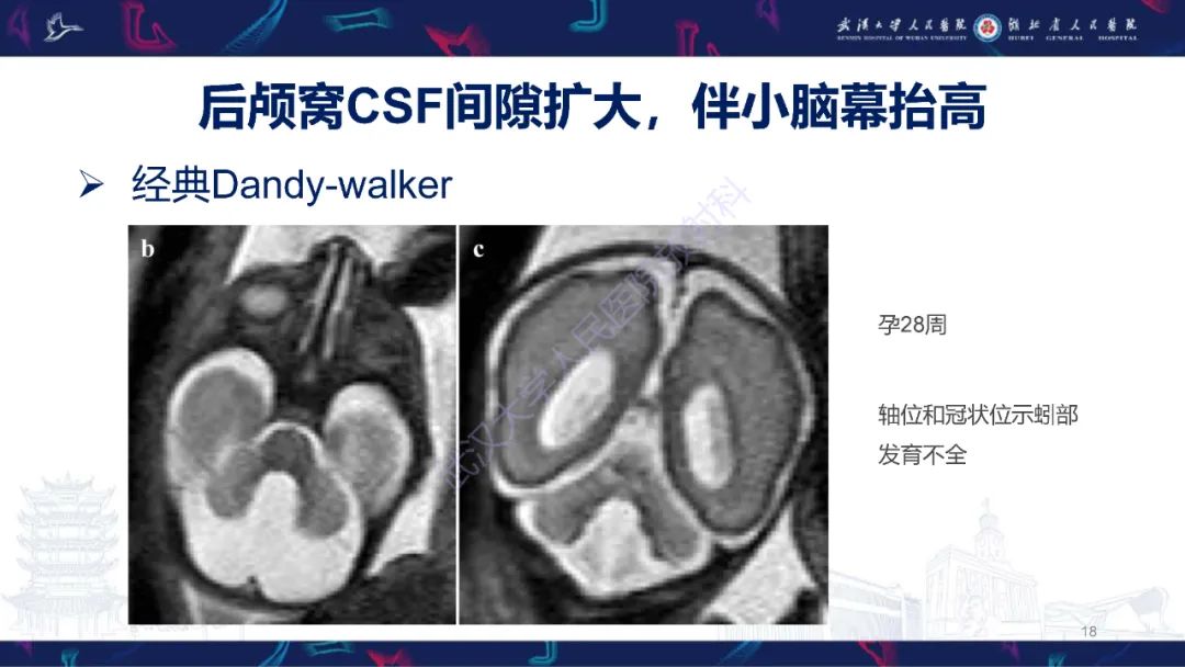 影像PPT - 【PPT】胎儿后颅窝畸形MRI诊断-18