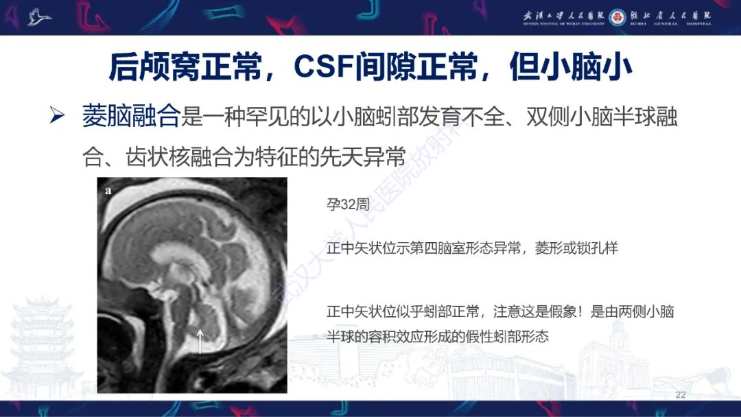 影像PPT - 【PPT】胎儿后颅窝畸形MRI诊断-22