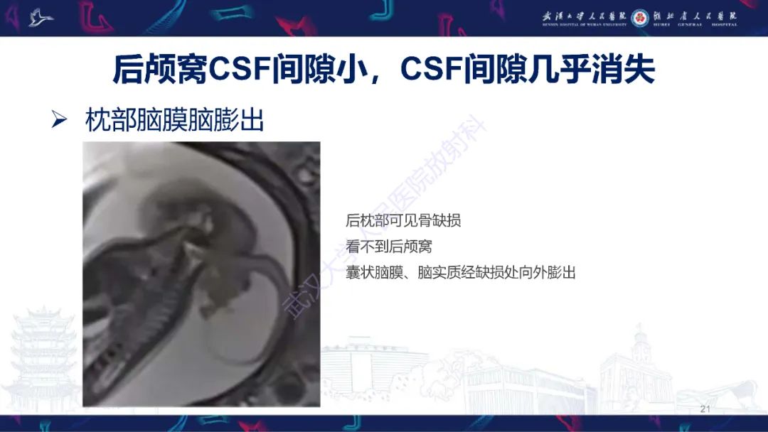 影像PPT - 【PPT】胎儿后颅窝畸形MRI诊断-21