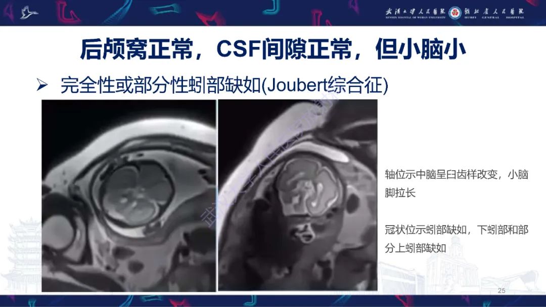 影像PPT - 【PPT】胎儿后颅窝畸形MRI诊断-25