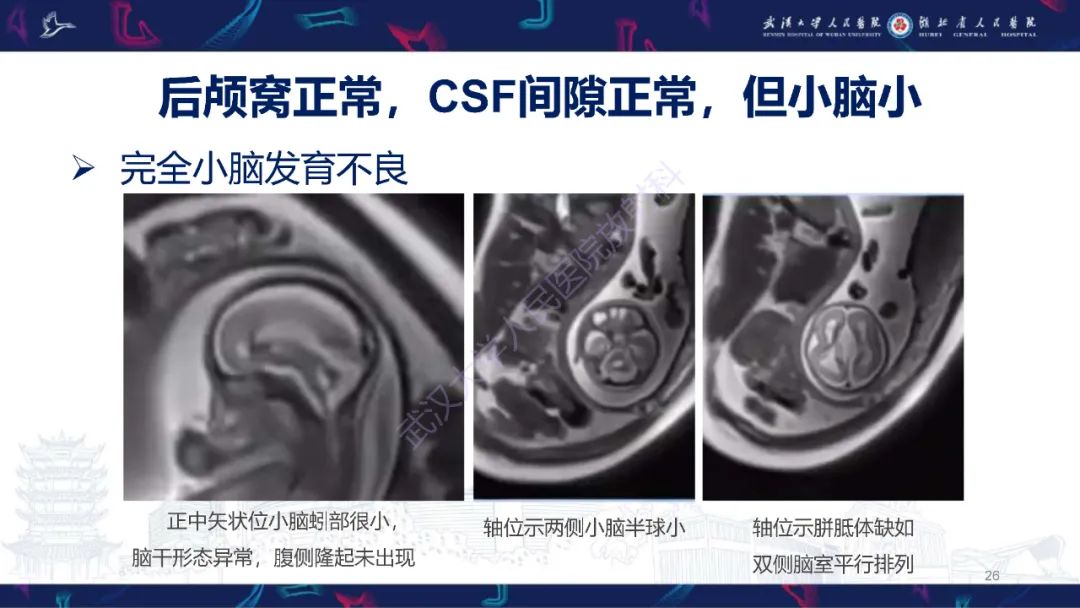 影像PPT - 【PPT】胎儿后颅窝畸形MRI诊断-26
