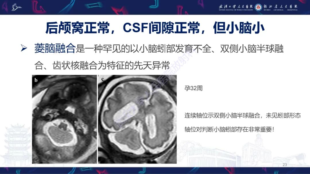 影像PPT - 【PPT】胎儿后颅窝畸形MRI诊断-23