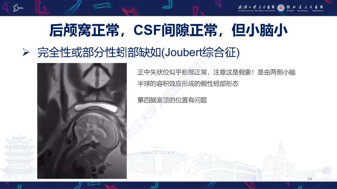 影像PPT - 【PPT】胎儿后颅窝畸形MRI诊断-24