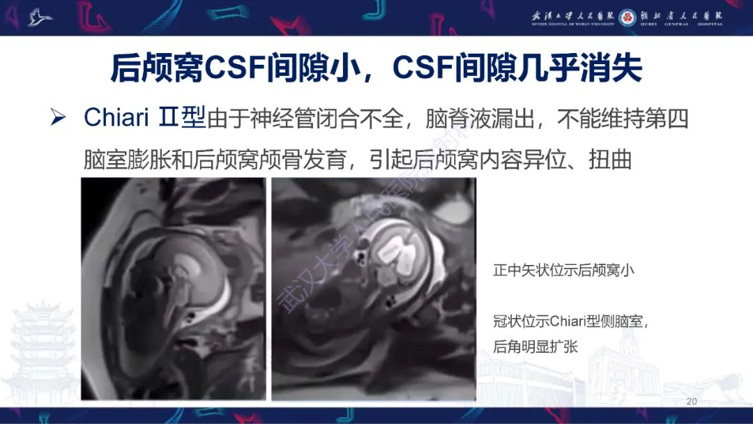 影像PPT - 【PPT】胎儿后颅窝畸形MRI诊断-20
