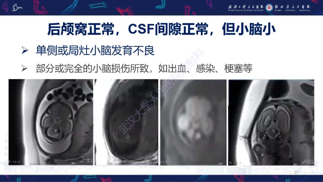 影像PPT - 【PPT】胎儿后颅窝畸形MRI诊断-27