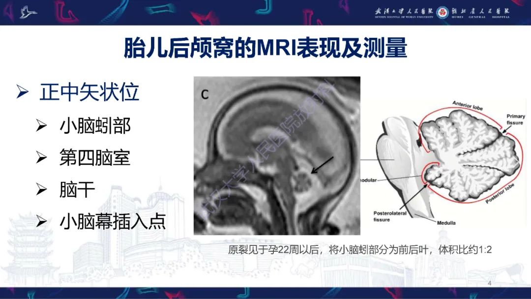 影像PPT - 【PPT】胎儿后颅窝畸形MRI诊断-1