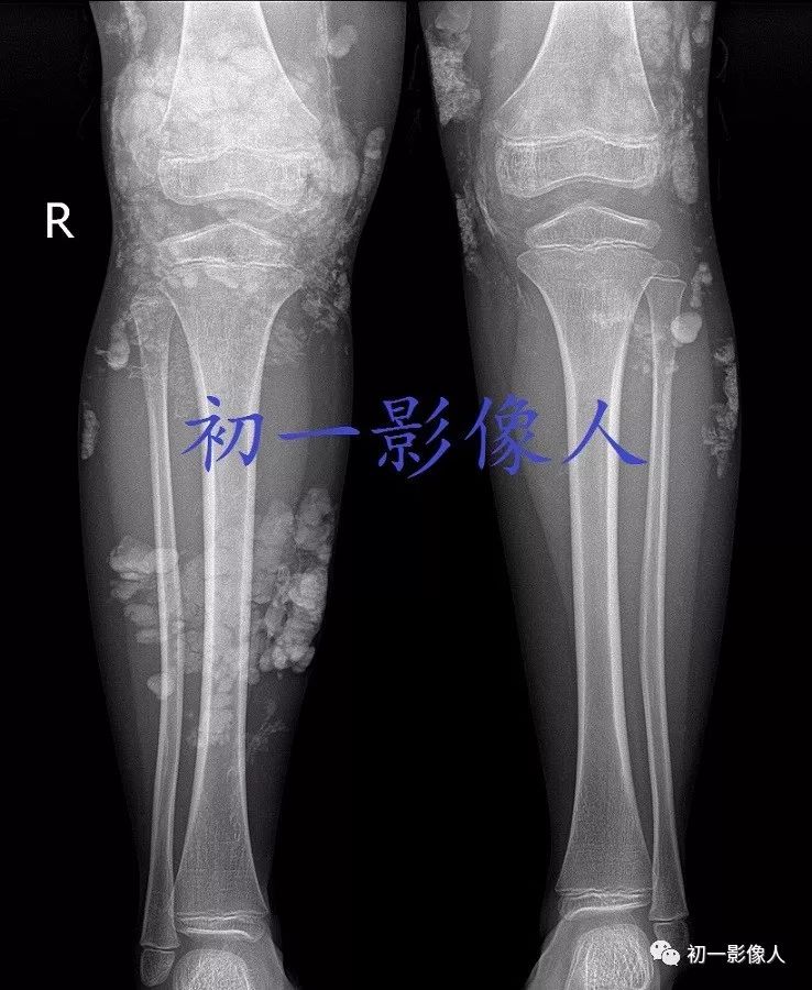 影像PPT - 儿童皮肌炎-2