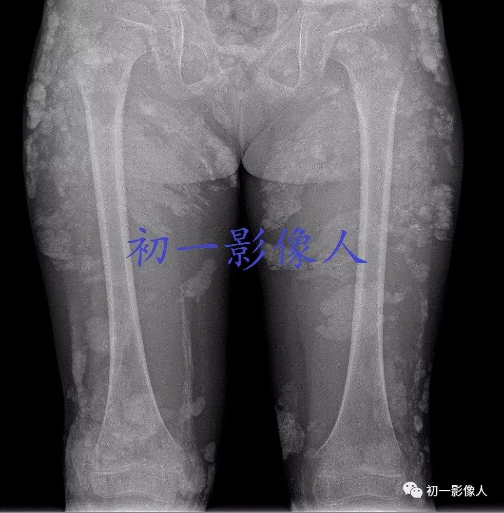 影像PPT - 儿童皮肌炎-1