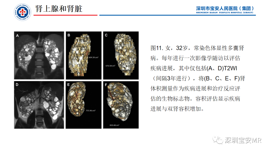 影像PPT - 【PPT】简化磁共振成像在腹部的应用-30
