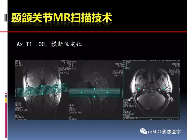影像PPT - 【PPT】颞下颌关节的磁共振成像（检查技术与解剖部分）-5