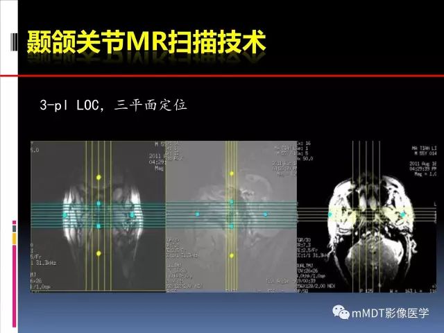 影像PPT - 【PPT】颞下颌关节的磁共振成像（检查技术与解剖部分）-4