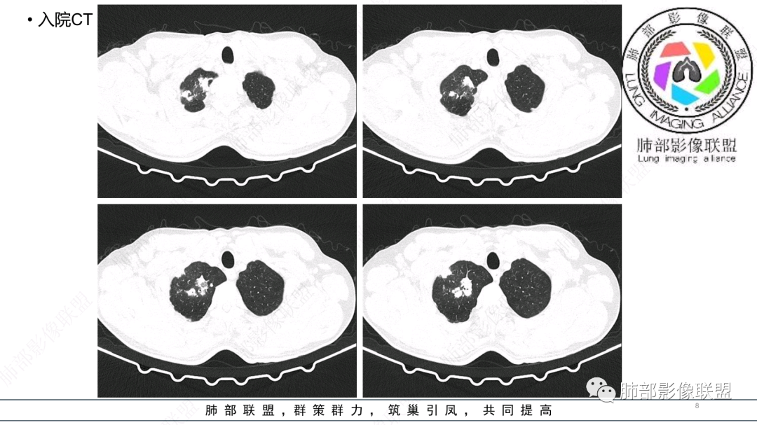 影像PPT - 【病例】 支扩基础上的感染,如何厘清头绪?-8 影像PPT - 【病例】 支扩基础上的感染,如何厘清头绪?-8