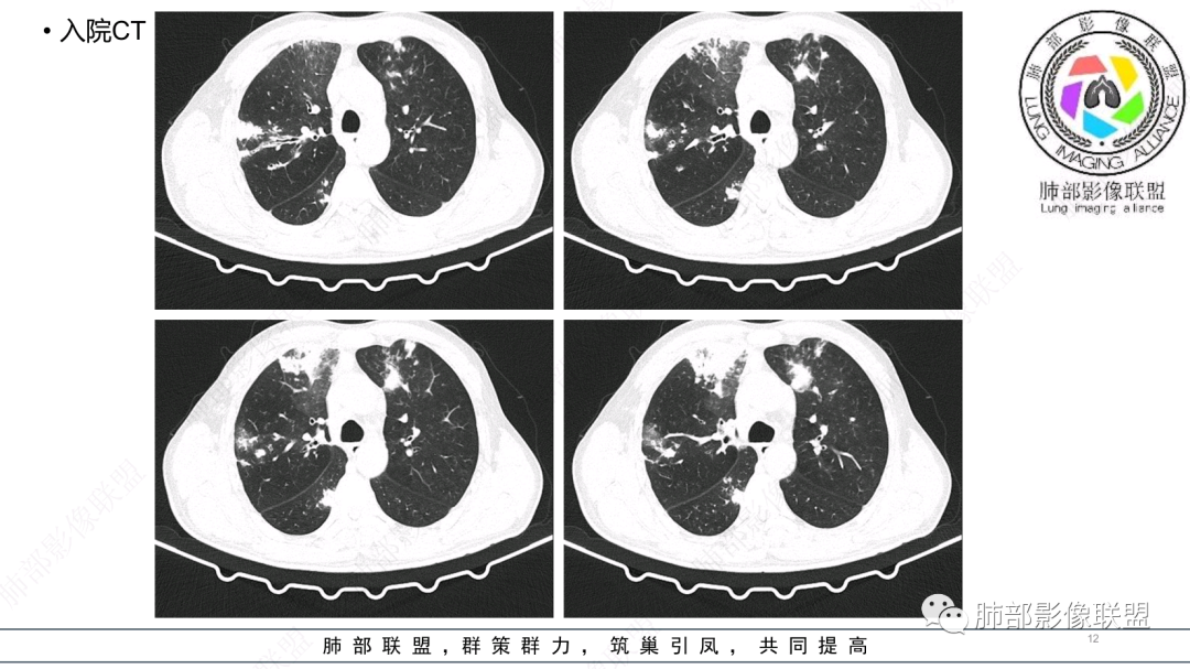 影像PPT - 【病例】 支扩基础上的感染,如何厘清头绪?-12 影像PPT - 【病例】 支扩基础上的感染,如何厘清头绪?-12