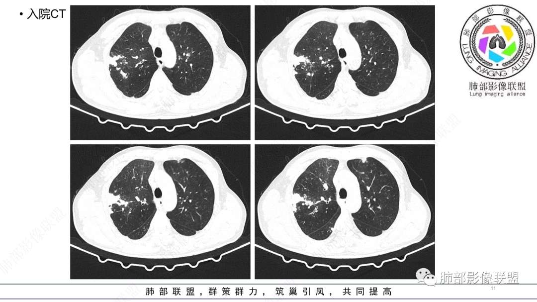 影像PPT - 【病例】 支扩基础上的感染,如何厘清头绪?-11 影像PPT - 【病例】 支扩基础上的感染,如何厘清头绪?-11