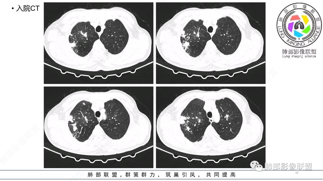 影像PPT - 【病例】 支扩基础上的感染,如何厘清头绪?-10 影像PPT - 【病例】 支扩基础上的感染,如何厘清头绪?-10