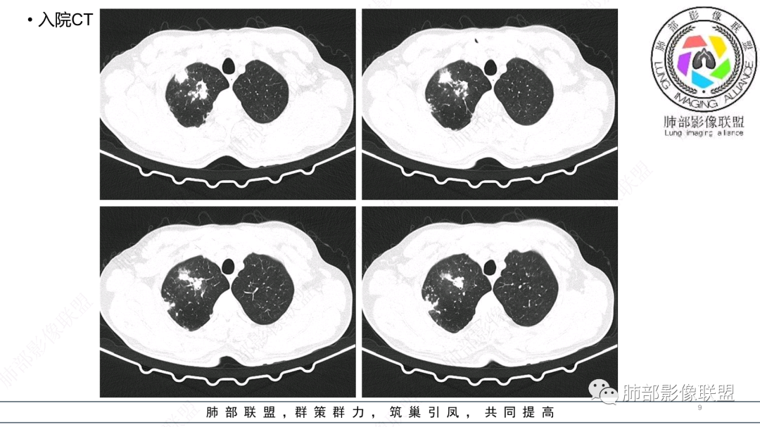影像PPT - 【病例】 支扩基础上的感染,如何厘清头绪?-9 影像PPT - 【病例】 支扩基础上的感染,如何厘清头绪?-9