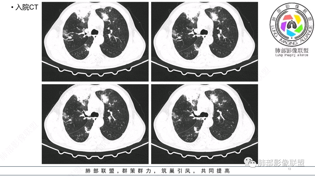 影像PPT - 【病例】 支扩基础上的感染,如何厘清头绪?-13 影像PPT - 【病例】 支扩基础上的感染,如何厘清头绪?-13