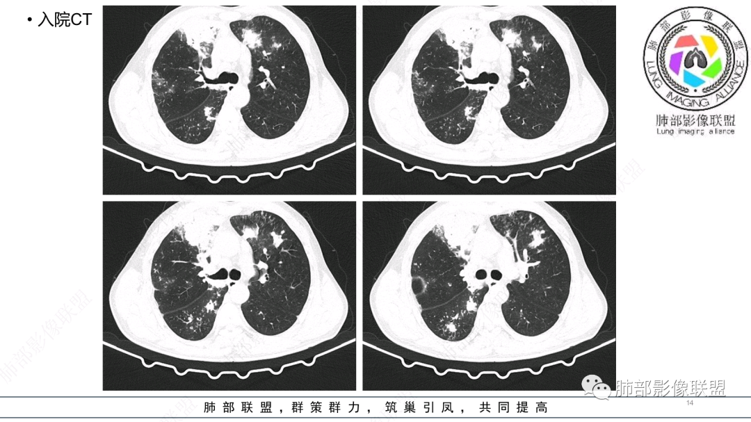 影像PPT - 【病例】 支扩基础上的感染,如何厘清头绪?-14 影像PPT - 【病例】 支扩基础上的感染,如何厘清头绪?-14