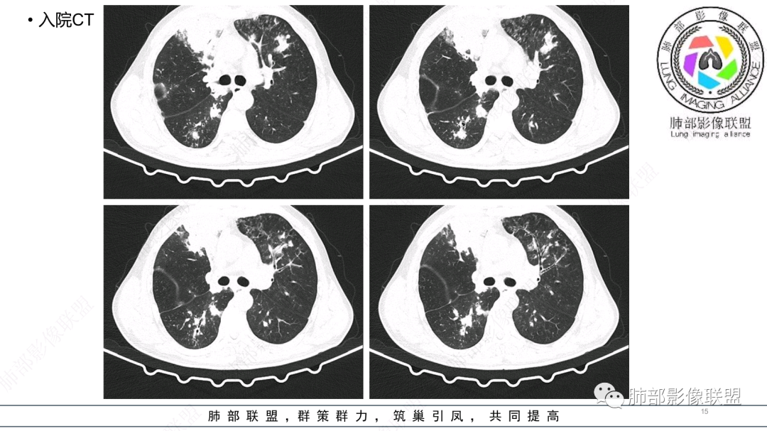 影像PPT - 【病例】 支扩基础上的感染,如何厘清头绪?-15 影像PPT - 【病例】 支扩基础上的感染,如何厘清头绪?-15