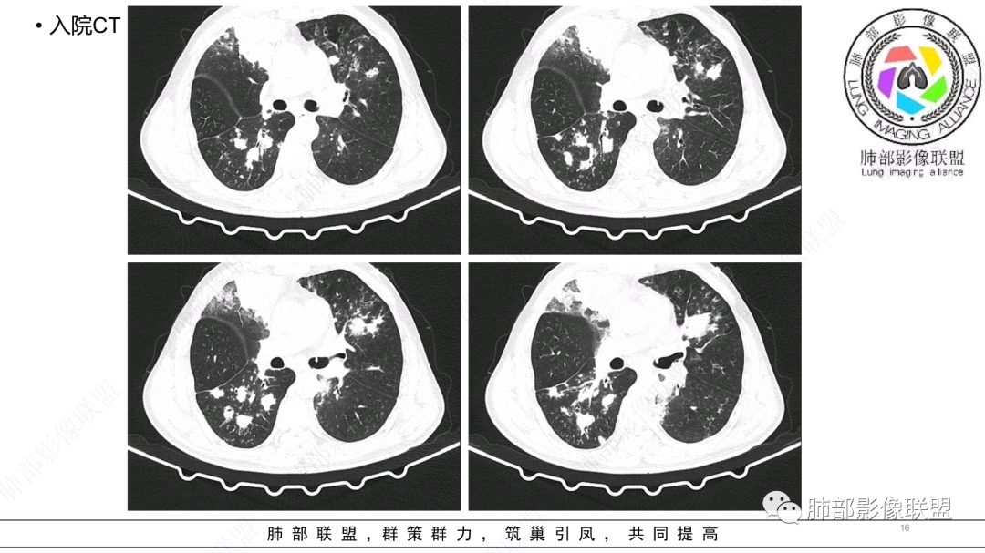 影像PPT - 【病例】 支扩基础上的感染,如何厘清头绪?-16 影像PPT - 【病例】 支扩基础上的感染,如何厘清头绪?-16