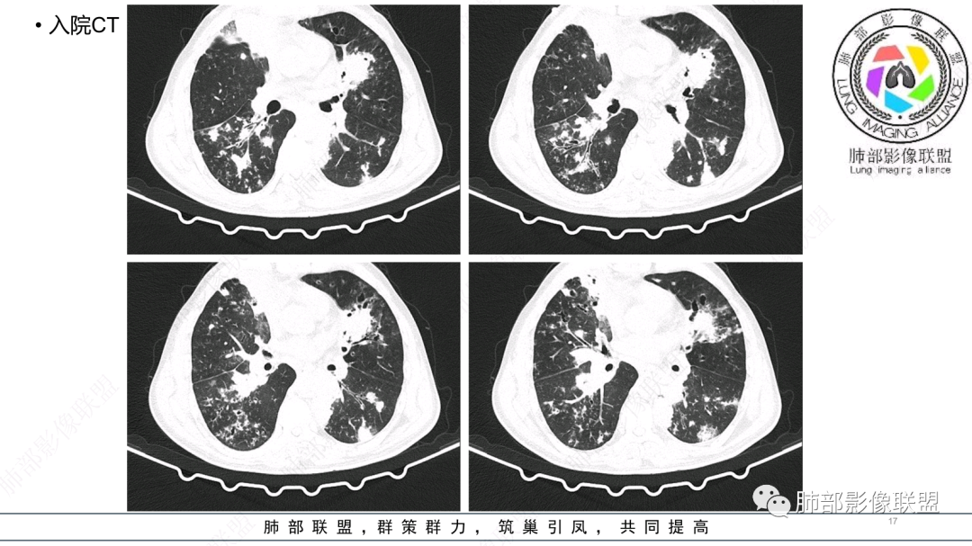 影像PPT - 【病例】 支扩基础上的感染,如何厘清头绪?-17 影像PPT - 【病例】 支扩基础上的感染,如何厘清头绪?-17