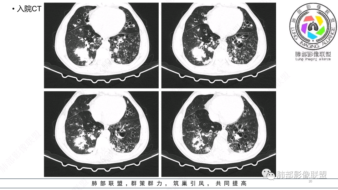 影像PPT - 【病例】 支扩基础上的感染,如何厘清头绪?-20 影像PPT - 【病例】 支扩基础上的感染,如何厘清头绪?-20