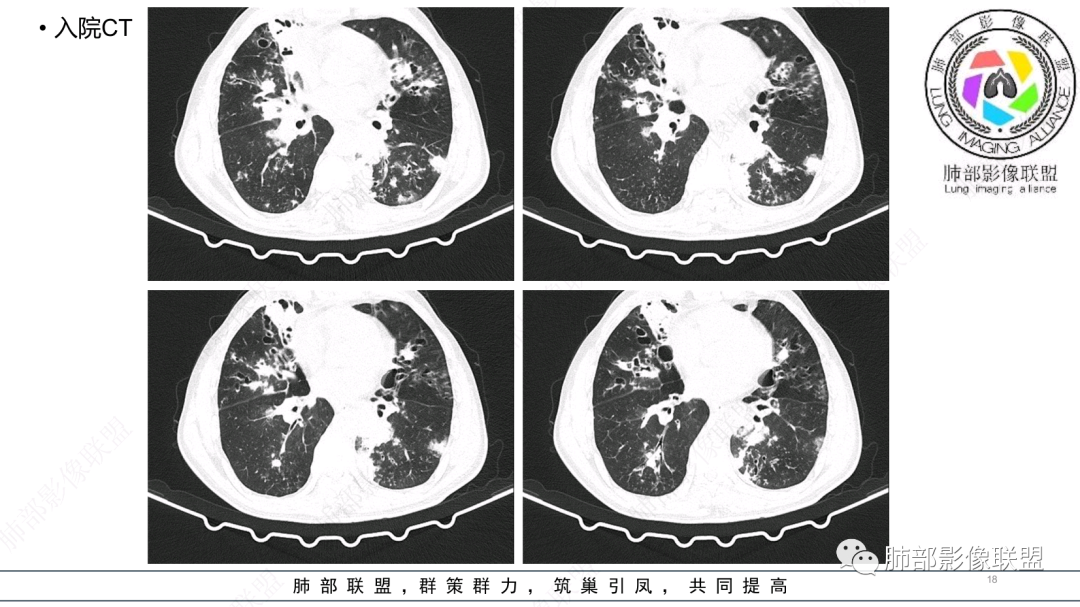 影像PPT - 【病例】 支扩基础上的感染,如何厘清头绪?-18 影像PPT - 【病例】 支扩基础上的感染,如何厘清头绪?-18