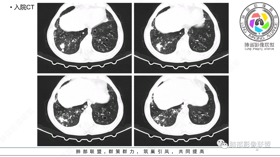 影像PPT - 【病例】 支扩基础上的感染,如何厘清头绪?-22 影像PPT - 【病例】 支扩基础上的感染,如何厘清头绪?-22