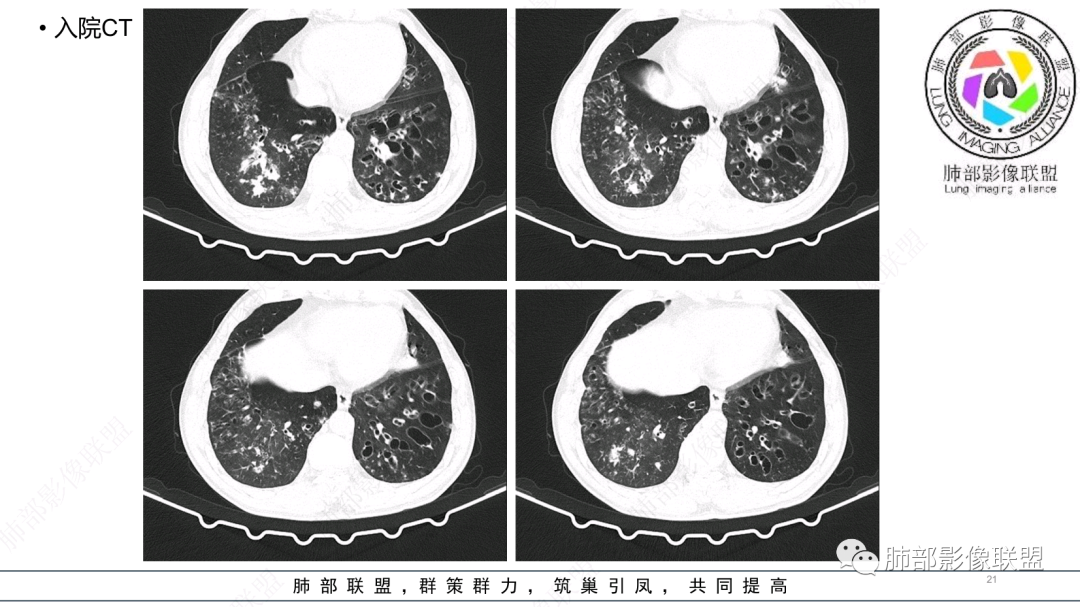 影像PPT - 【病例】 支扩基础上的感染,如何厘清头绪?-21 影像PPT - 【病例】 支扩基础上的感染,如何厘清头绪?-21