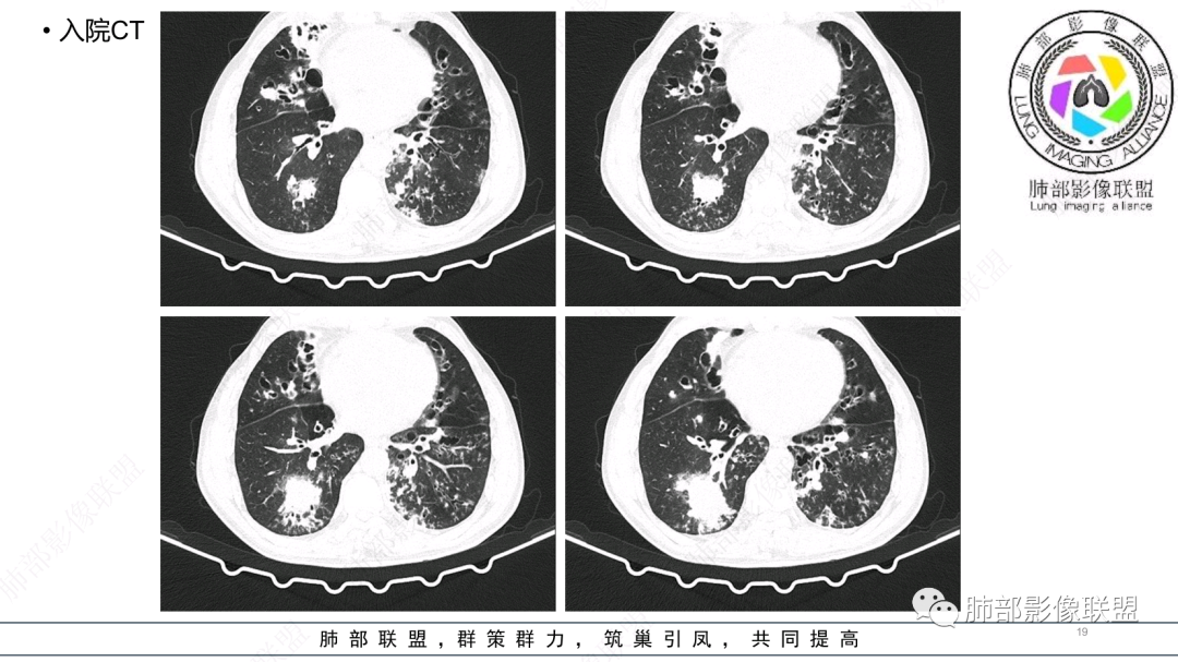 影像PPT - 【病例】 支扩基础上的感染,如何厘清头绪?-19 影像PPT - 【病例】 支扩基础上的感染,如何厘清头绪?-19