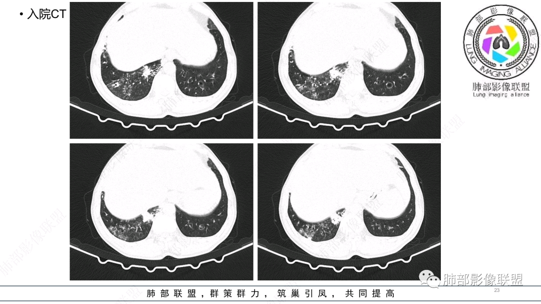 影像PPT - 【病例】 支扩基础上的感染,如何厘清头绪?-23 影像PPT - 【病例】 支扩基础上的感染,如何厘清头绪?-23