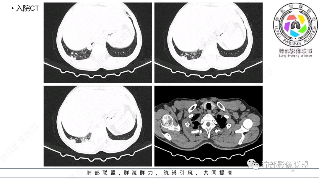 影像PPT - 【病例】 支扩基础上的感染,如何厘清头绪?-24 影像PPT - 【病例】 支扩基础上的感染,如何厘清头绪?-24