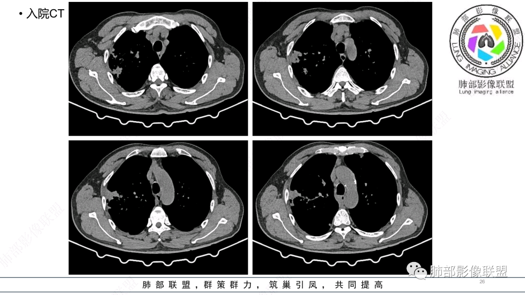 影像PPT - 【病例】 支扩基础上的感染,如何厘清头绪?-26 影像PPT - 【病例】 支扩基础上的感染,如何厘清头绪?-26