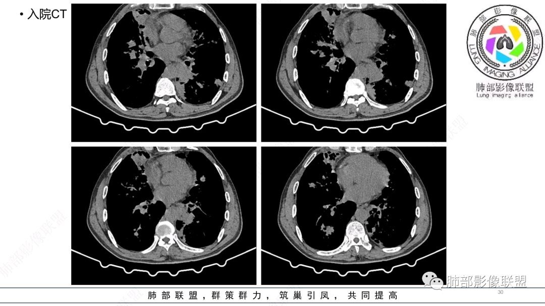 影像PPT - 【病例】 支扩基础上的感染,如何厘清头绪?-30 影像PPT - 【病例】 支扩基础上的感染,如何厘清头绪?-30