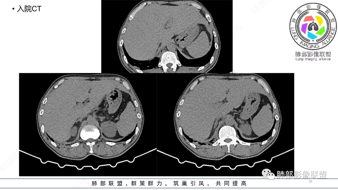 影像PPT - 【病例】 支扩基础上的感染,如何厘清头绪?-33 影像PPT - 【病例】 支扩基础上的感染,如何厘清头绪?-33