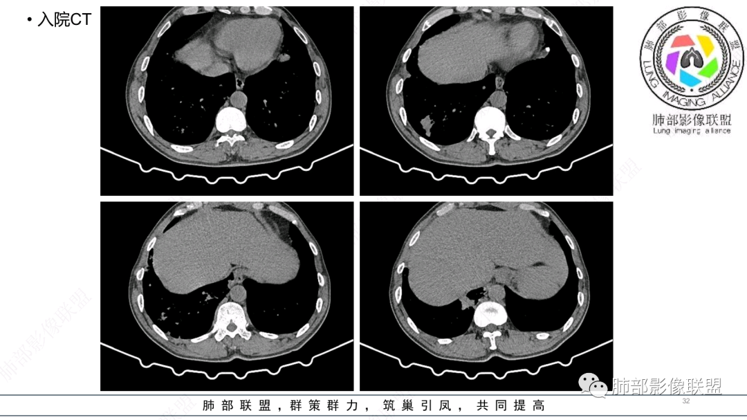 影像PPT - 【病例】 支扩基础上的感染,如何厘清头绪?-32 影像PPT - 【病例】 支扩基础上的感染,如何厘清头绪?-32