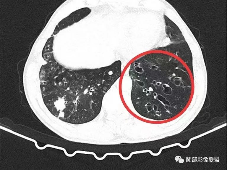 影像PPT - 【病例】 支扩基础上的感染,如何厘清头绪?-41 影像PPT - 【病例】 支扩基础上的感染,如何厘清头绪?-41