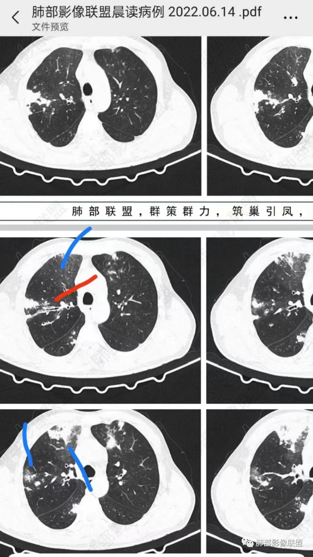 影像PPT - 【病例】 支扩基础上的感染,如何厘清头绪?-45 影像PPT - 【病例】 支扩基础上的感染,如何厘清头绪?-45