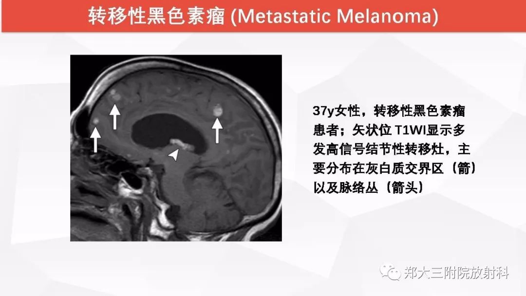 影像PPT - 【PPT】颅内T1WI高信号病变的影像鉴别诊断-16