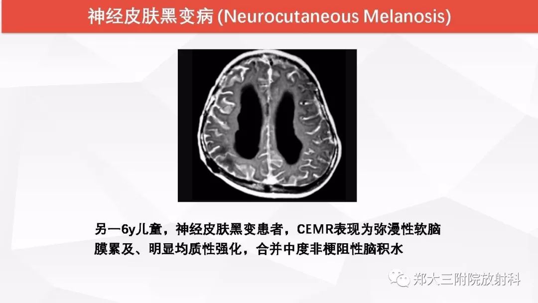 影像PPT - 【PPT】颅内T1WI高信号病变的影像鉴别诊断-21