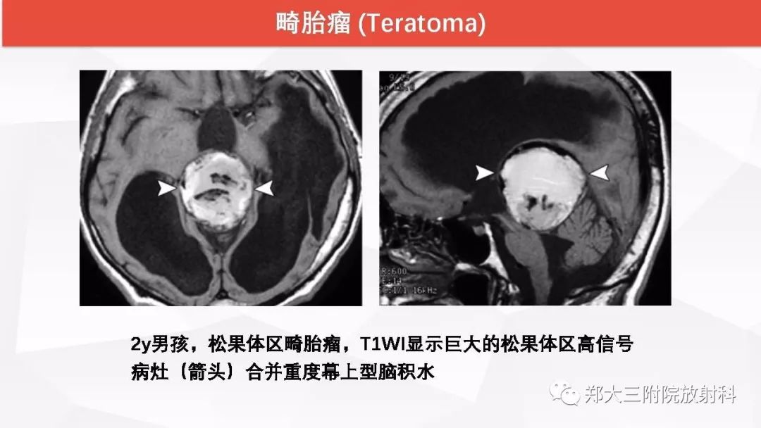 影像PPT - 【PPT】颅内T1WI高信号病变的影像鉴别诊断-26