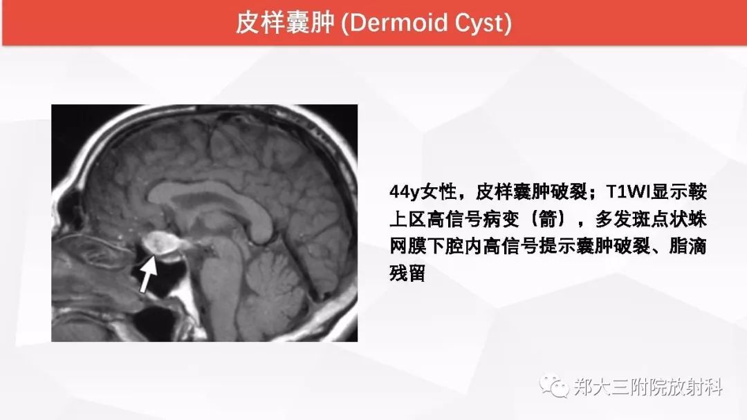 影像PPT - 【PPT】颅内T1WI高信号病变的影像鉴别诊断-28
