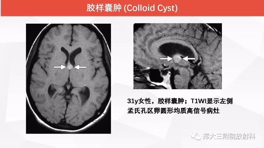 影像PPT - 【PPT】颅内T1WI高信号病变的影像鉴别诊断-31