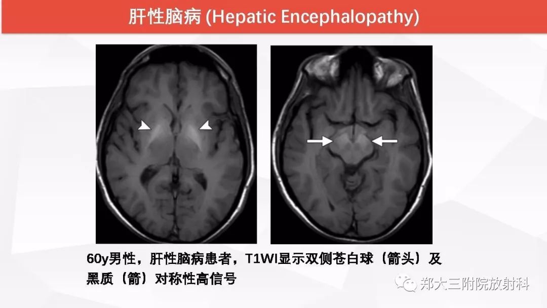 影像PPT - 【PPT】颅内T1WI高信号病变的影像鉴别诊断-36