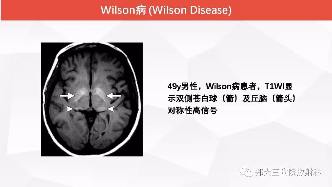 影像PPT - 【PPT】颅内T1WI高信号病变的影像鉴别诊断-38