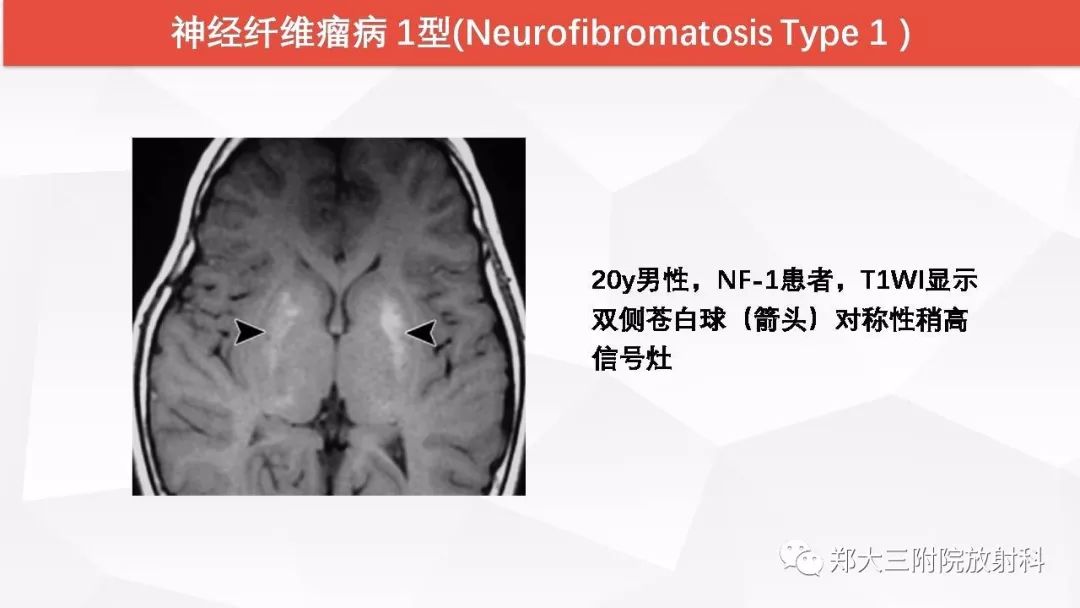 影像PPT - 【PPT】颅内T1WI高信号病变的影像鉴别诊断-41