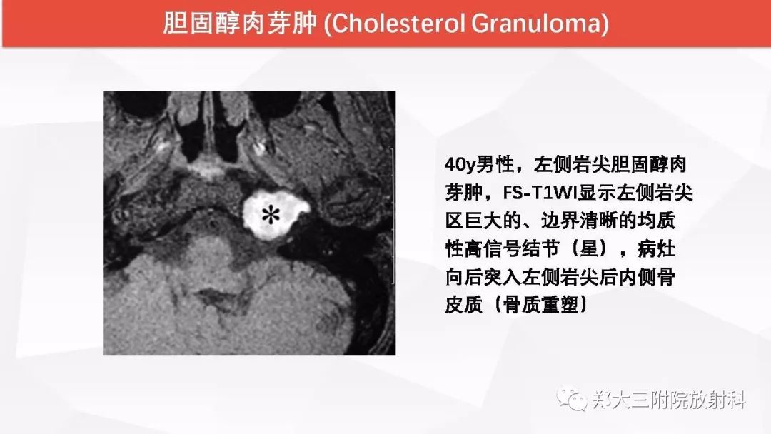 影像PPT - 【PPT】颅内T1WI高信号病变的影像鉴别诊断-43