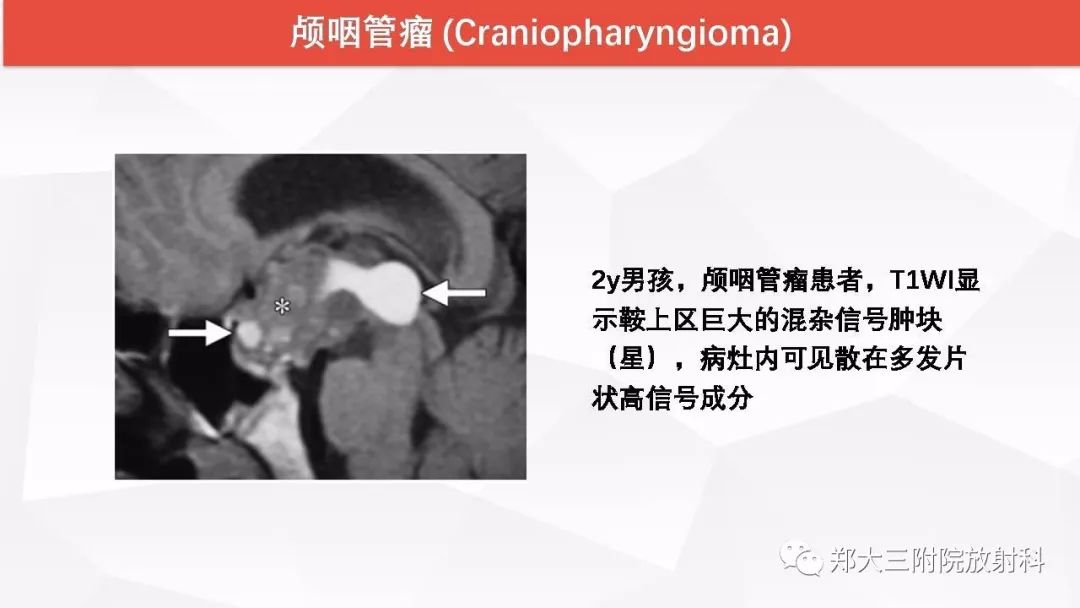 影像PPT - 【PPT】颅内T1WI高信号病变的影像鉴别诊断-45