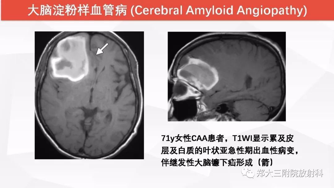 影像PPT - 【PPT】颅内T1WI高信号病变的影像鉴别诊断-5