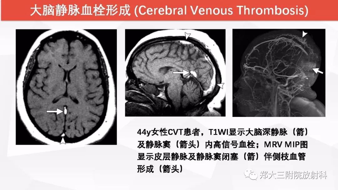 影像PPT - 【PPT】颅内T1WI高信号病变的影像鉴别诊断-7